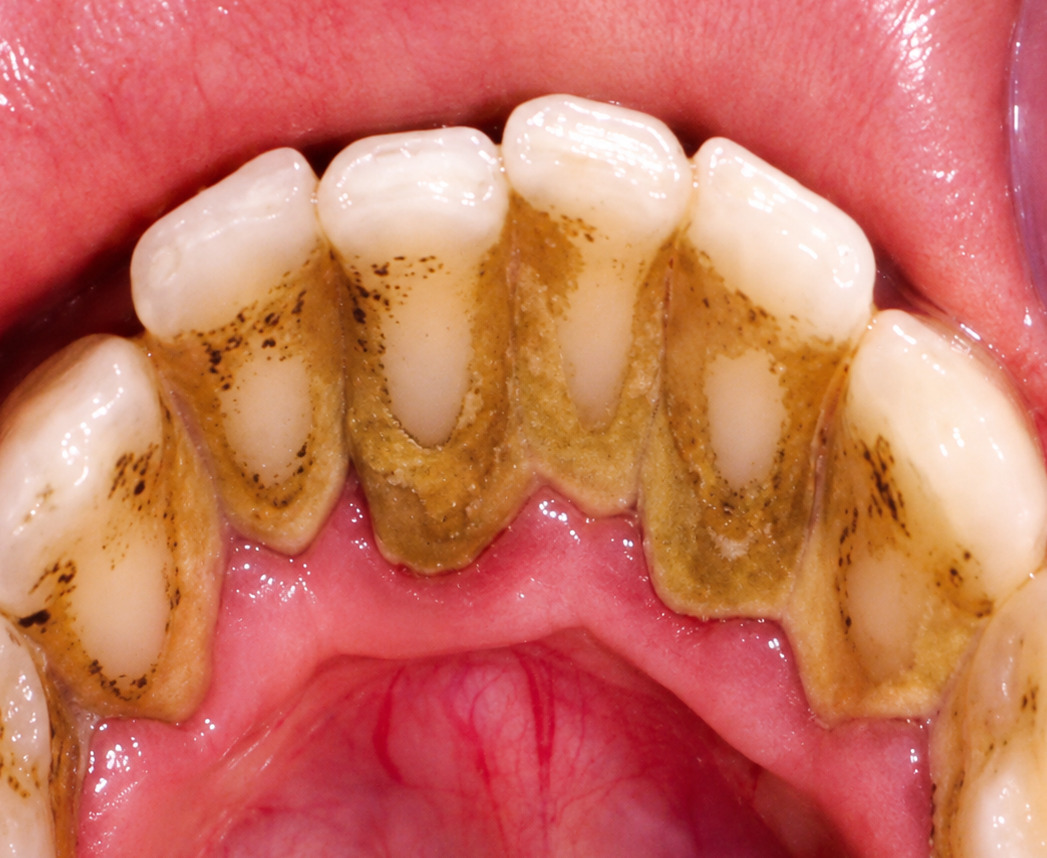 Antes da limpeza dental